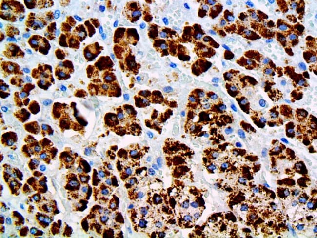 Label: Immunohistochemistry of adrenal tissue demonstrating strong STAR (steroidogenic acute regulatory protein) immunoreactivity. Modality: brightfield immunohistochemistry on a formalin-fixed paraffin-embedded adrenal cortex section. Primary target: STAR protein localized to the cytoplasm of steroidogenic adrenal cortical cells, with intense granular brown DAB signal and a light hematoxylin counterstain for nuclei. Imaging: high-magnification microscopic view showing diffuse, strong cytoplasmic staining across the cortex with preserved tissue architecture in cords and trabeculae. Biological relevance: STAR mediates cholesterol transport into mitochondria and the rate-limiting step of pregnenolone synthesis; its expression marks functional steroidogenesis. Diagnostic significance: STAR is a sensitive and specific marker for steroid-producing cells; in testicular pathology it differentiates sex cord-stromal tumors from germ cell tumors; in adrenal tissue it confirms steroidogenic lineage, and can aid in characterizing adrenocortical tumors versus non-steroid producing neoplasms. Technical notes: DAB chromogen yields brown precipitate; hematoxylin counterstain provides blue nuclei; no counterstain or contrast agent beyond standard reagents. Comparative considerations: positive STAR supports a steroidogenic phenotype, whereas absence suggests non-steroidogenic lineage; integration with additional markers (SF-1, inhibin, p450(c17)) improves diagnostic confidence. Educational utility: illustrates immunophenotype of STAR in adrenal cortex and related tissues, with implications for endocrinology, surgical pathology, and oncology.