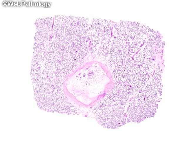 Digital whole-slide histology image of a testicular parenchymal section stained with Hematoxylin and Eosin (H&E), captured as a high-resolution slide to illustrate a partially regressed Leydig cell tumor. The lesion is well-circumscribed and hyalinized, located in the interstitial compartment adjacent to normal seminiferous tubules. The tumor area is largely supplanted by vascularized fibroconnective tissue, producing a prominent fibrous core with few residual clusters of Leydig tumor cells, which exhibit eosinophilic cytoplasm and occasional nuclear atypia, set within a fibrotic stroma. The surrounding tubules appear morphologically normal, with preserved spermatogenic epithelium at the periphery. The histologic pattern is consistent with sex cord-stromal neoplasm of Leydig cell lineage, but with marked regression; immunohistochemical confirmation (inhibin-α, calretinin, Melan-A) would support Sertoli-Leydig differentiation and help exclude germ cell tumors such as seminoma. The diagnostic significance lies in recognizing regression/regenerative changes in Leydig cell tumors, which may mimic fibrous scar or other testicular neoplasms on gross exam and cytology. Differential considerations include germ cell tumors (seminoma, embryonal carcinoma) and Sertoli cell tumors; clinical correlation with hormonal profile and imaging aids management decisions. This image is valuable for education, pathology review, and research on gonadal tumor regression and stromal remodeling.