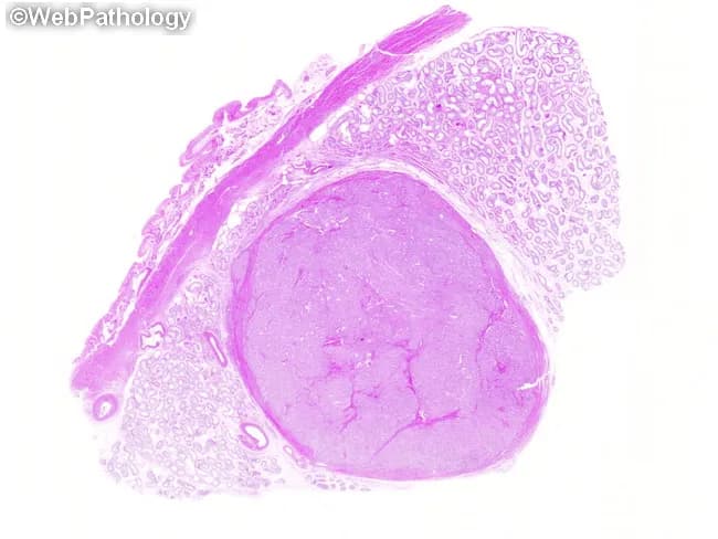 Imaging modality and technique: Hematoxylin and eosin (H&E) stained histopathology slide of testicular tissue examined under light microscopy at low power. The specimen shows a small, well-circumscribed intratesticular mass within the testicular parenchyma. Tunica albuginea is identifiable at the upper left border, establishing an intraparenchymal location. The lesion displays cords and tubule-like structures lined by tall, uniform Sertoli cells with oval nuclei and scant cytoplasm, set in a fibrous to densely collagenous stroma. The tumor margin appears sharp, with preservation of adjacent seminiferous tubule architecture and only mild adjacent tubulopathy. No overt necrosis, hemorrhage, or significant cytologic atypia is seen in this field. These features are characteristic of a Sertoli cell tumor, a sex cord-stromal neoplasm of the testis that is typically small and well circumscribed. Clinically, Sertoli cell tumors may present as a testicular mass and are often benign but can occasionally show malignant potential; differential diagnosis includes germ cell tumors such as seminoma, as well as Leydig cell tumor and fibroma. Immunohistochemistry (if performed) may show Sertoli cell markers (e.g., cytokeratin, inhibin) supporting the diagnosis. This image is valuable for educational and diagnostic context, aiding tumor characterization and surgical planning. Useful for radiology-pathology correlation and tumor typing education.