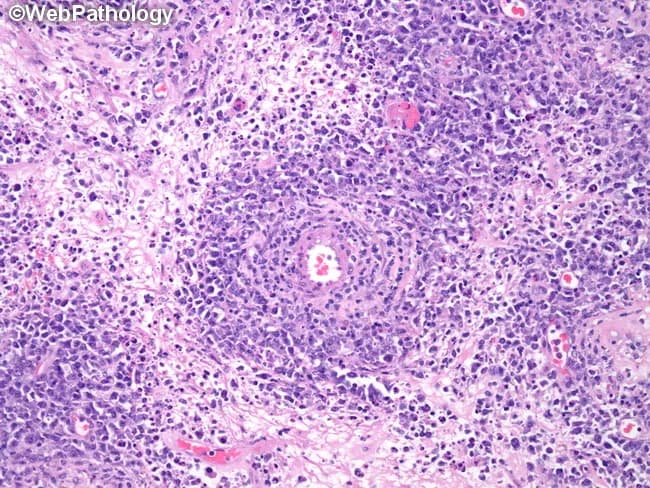 A high-magnification histopathology image of testicular tissue with diffuse large B-cell lymphoma (DLBCL), an extranodal non-Hodgkin lymphoma. Hematoxylin and eosin staining highlights sheets of large lymphoid cells with vesicular nuclei, prominent nucleoli, and scant to moderate cytoplasm that collectively efface the normal testicular architecture. A distinctive feature is a perivascular cuff of viable tumor cells surrounding a small blood vessel, illustrating focal preservation of subtle stromal vascularity within an extensively infiltrated parenchyma. Scattered mitotic figures and areas of geographic necrosis may be present, underscoring tumor aggressiveness. Immunophenotypic expectations for DLBCL include CD20 and PAX5 positivity with variable expression of CD10, BCL6, and MUM1, and a high Ki-67 proliferation index, though these are not directly demonstrated in the image. Clinically, testicular DLBCL commonly presents as an enlarging scrotal mass in adults and carries a risk of systemic spread, including CNS involvement; management typically combines systemic chemotherapy with CNS prophylaxis in select cases. This image is educational for lymphoma histology, differential diagnosis (e.g., Burkitt lymphoma, seminoma with dense lymphocytic infiltrate), and pathology–clinical correlation in testicular neoplasms. This contextualizes the image for educational use in tumor classification, hematopathology seminars, and informatics-based research datasets emphasizing morphology, perivascular patterns, and necrotic heterogeneity in aggressive B-cell lymphomas.