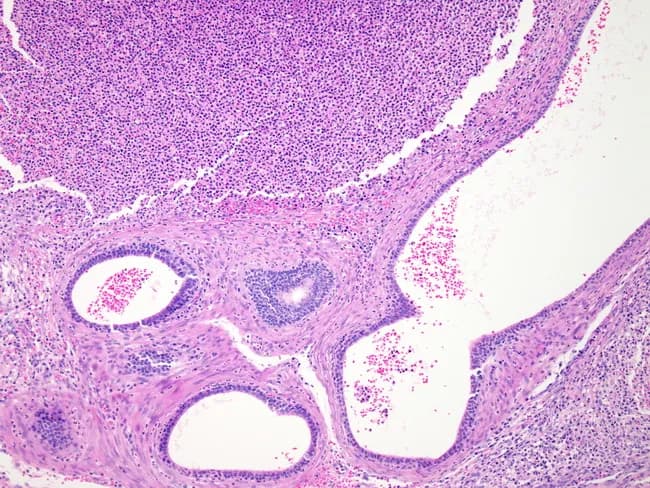 This is a histopathology image (bright-field microscopy) of epididymal tissue illustrating acute epididymitis with associated inflammatory changes. Acquired from epididymal tubules, paraffin-embedded, section stained with hematoxylin and eosin and viewed at low-to-moderate magnification. The specimen depicts hyperemic, edematous epididymal tissue with expanded interstitium and congested vasculature. The luminal tubules are filled with creamy fibrinopurulent exudate, consistent with acute suppurative infection. Microabscesses are present in the top half of the image, reflecting focal collections of neutrophils within tubules or luminal luminal debris. The epithelial lining may be disrupted, and tubular architecture is partially destroyed by inflammatory destruction. The surrounding stroma shows dense inflammatory infiltrate and edema; occasional gland-like structures persist but are variably preserved. The histologic appearance corresponds to bacterial epididymitis, often arising via retrograde spread from the urinary tract or hematogenous seeding. Clinically, this pattern supports a diagnosis of acute epididymitis with possible epididymo-orchitis; organisms such as gram-negative rods (E. coli, N. gonorrhoeae) may be implicated. Recognition of microabscesses and tubular destruction informs prognosis and therapeutic planning, including targeted antibiotic therapy and evaluation for urinary tract source. This image is valuable for education on epididymal inflammatory pathology, differential diagnosis with torsion or chronic epididymitis, and research into host–pathogen interactions in male genital tract infection.