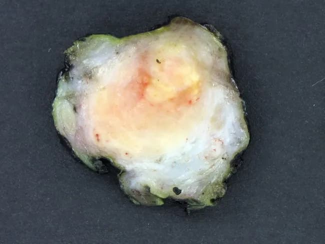 This gross pathology photograph depicts a transverse cross-section of an enlarged epididymis with a centralized, cheese-colored (caseous) necrotic core surrounded by a pale fibrous band. The lesion is consistent with tuberculous epididymo-orchitis, a commonly coexisting genitourinary TB process where granulomatous inflammation frequently involves multiple GU sites such as the prostate or testis and may accompany renal or pulmonary tuberculosis. On the cut surface, the necrotic center contrasts with the surrounding fibrous capsule and residual epididymal parenchyma, reflecting chronic granulomatous disease with fibrosis and scarring. Clinically, patients may report mild scrotal pain, enlargement, low-grade discomfort, infertility, or asymptomatic masses; urinary abnormalities or systemic signs of tuberculosis can be minimal. This image illustrates the macroscopic hallmarks of tuberculosis in the epididymis: caseation necrosis, granuloma formation, and progressive fibrosis. In differential diagnosis, bacterial epididymo-orchitis or fungal granulomatous infections may be considered, but the presence of central caseation strongly supports TB. This specimen is valuable for medical education, pathology training, and research on genitourinary tuberculosis, aiding correlation with histopathology, microbiology, and radiologic findings, and facilitating discussion of diagnostic workup, including urine culture, nucleic acid amplification tests, and anti-tubercular therapy planning. This description enables precise search indexing for TB epididymitis in clinical databases and research.