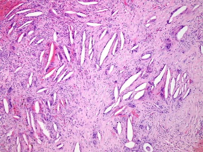 Light microscopy of a thickened hydrocele wall from tunica vaginalis demonstrates cross-sectional histology with dense fibrous stroma, scattered inflammatory cells, and cholesterol clefts. Acute neutrophilic bands and chronic lymphoplasmacytic infiltrates coexist, while multinucleated foreign body giant cells form around cholesterol clefts, reflecting a cholesterol granulomatous reaction. Fibrosis is prominent, with fascicular, collagen-rich architecture and minimal residual lining. The observed histology indicates chronic inflammatory and granulomatous response to leaked or degraded hydrocele contents, superimposed infection, and scarring. Diagnostic significance includes evidence of infectious complication and chronicity; findings support secondary infection in a long-standing hydrocele and help differentiate from neoplastic or purely serous processes. Clinically relevant search terms: hydrocele wall pathology, tunica vaginalis inflammation, cholesterol granuloma, foreign body giant cell reaction, chronic infection, fibrosis, scrotal hydrocele, hydrocelectomy planning, granulomatous scrotal disease.
