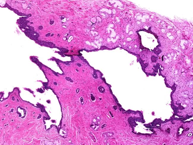 This histopathology slide depicts a Bartholin gland cyst, a common vulvar lesion resulting from cystic dilation of the Bartholin (greater vestibular) gland or its duct due to ductal obstruction, often in the setting of prior infection. In this Hematoxylin and Eosin stained preparation, low-power examination reveals a dilated duct-like structure with an anechoic to mucinous luminal content, lined by a simple to transitional-type epithelium. The cyst wall contains scattered mucous glands embedded in fibrous stroma, reflecting residual glandular architecture. The surrounding vulvar stroma displays mild chronic inflammatory infiltrate and fibrosis, compatible with retention of secretions rather than suppurative abscess. The glands are located in the posterior-lateral vestibule behind the labia minora, and drainage occurs into the postero-lateral vestibular recess. Pathology confirms a benign lesion with no dysplasia or malignancy detected in this field. Clinically, Bartholin cysts present as a unilateral vulvar mass, often fluctuating in size, and can become painful if infected (Bartholin gland abscess). This histology underscores the importance of recognizing ductal obstruction with mucus retention and glandular mucin production. Therapeutically, management may include marsupialization or gland excision depending on size, recurrence, and suspicion of neoplasm. In educational and diagnostic contexts, this image aids training in vulvar histopathology, differential with abscess or neoplasm, and correlates with clinical vulvar swelling.
