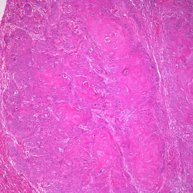 Imaging modality and technique: Not applicable in this field; however for description, histology uses light microscopy of hematoxylin and eosin stained vulvar biopsy tissue. Observed pattern: invasive keratinizing squamous cell carcinoma arising in vulvar epidermis with invasion into the dermis. Precise anatomy: vulvar external genitalia; epithelium of the labia majora/minora and adjacent hymenal region may be involved; depth of invasion is a key prognostic factor. Visual features: tumor nests and cords of malignant squamous cells with marked cellular pleomorphism, hyperchromatic nuclei, increased mitotic figures, and intercellular bridges. Keratinization with formation of keratin pearls is present; desmoplastic stromal reaction and chronic inflammatory infiltrate at invasion front. The lesion may display well to moderately differentiated features, with conspicuous keratinization characteristic of the keratinizing subtype. HPV-independent pathogenesis is typical for this vulvar carcinoma variant; the alternative HPV-associated basaloid/warty subtype occurs in younger women. Diagnostic significance: histology confirms diagnosis of vulvar squamous cell carcinoma and determines subtype, which has implications for HPV status, prognosis, and treatment planning (wide local excision, sentinel lymph node biopsy, radiotherapy). Potential clinical utility: aids differential diagnosis in elderly patients with vulvar lesions, informs prognosis, guides surgical planning, and supports educational or research use in gynecologic oncology.