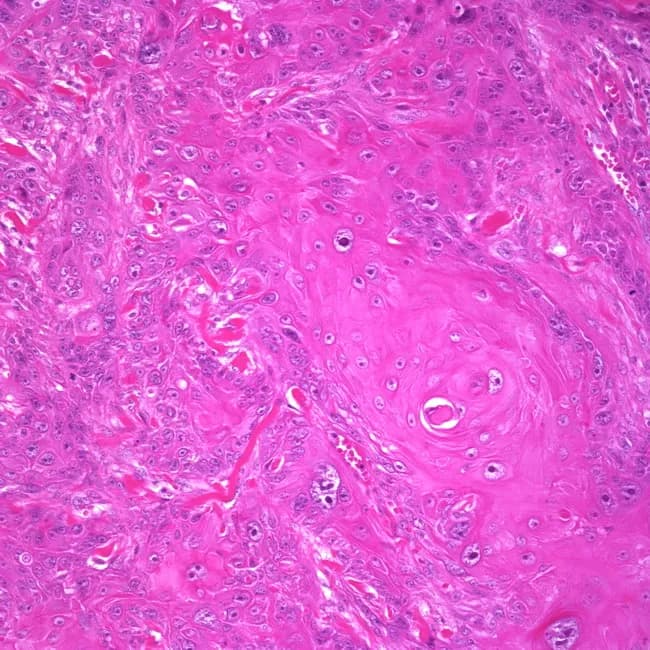 High-power light microscopic histology of vulvar tissue demonstrates invasive, well-differentiated keratinizing squamous cell carcinoma centered on the labium majus. The specimen shows malignant squamous cells arranged in nests and radiating cords with orderly keratinization and conspicuous keratin pearl formation within desmoplastic stroma. Individual tumor cells exhibit abundant eosinophilic cytoplasm, polygonal outlines, intercellular bridges, hyperchromatic rounded to angulated nuclei, and mitotic activity is present but not excessive in this field. Invasion through the squamous epithelium into the underlying dermis is evident, with variable stromal reaction and a lymphocytic inflammatory component. The keratinizing phenotype and absence of conspicuous koilocytosis or basaloid features favor a traditional keratinizing vulvar squamous cell carcinoma as opposed to HPV-associated basaloid or warty subtypes. The appearance aligns with a histologic diagnosis of invasive vulvar SCC; depth of invasion and perineural or lymphovascular invasion risk require correlation with surgical margins and regional nodal status. Clinically, this entity is associated with vulvar mass and potential regional metastasis; management typically involves radical vulvectomy with bilateral inguinal lymph node dissection or equivalent radiotherapeutic strategies depending on staging. This image supports diagnostic confirmation, guides surgical planning, and informs prognosis and follow-up strategies. Accurate staging and multidisciplinary coordination remain critical for optimal outcomes globally.