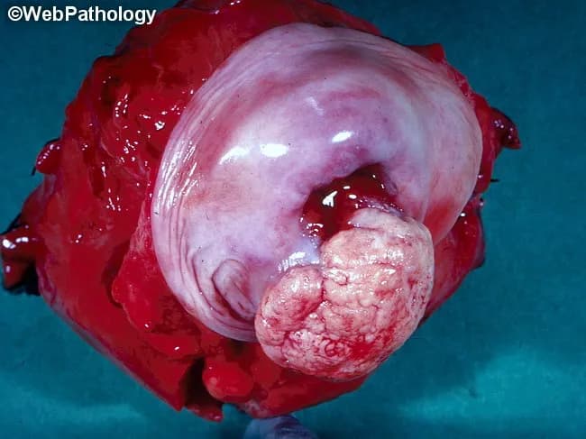 Gross pathology photograph of a cervix demonstrating a polypoid hemorrhagic mass arising from the external os. The exophytic tumor projects into the endocervical canal and displays a friable, fleshy surface with areas of hemorrhage. The lesion is large, pedunculated, with a pink-white, smooth to lobulated exterior and a red, hemorrhagic core. Microscopically, the lesion is a keratinizing moderately-differentiated squamous cell carcinoma. Tumor cells form nests with keratinization and intercellular bridges, producing keratin pearls. There is invasion of the underlying stroma with desmoplastic response and variable mitotic activity. The tumor demonstrates features typical of cervical squamous cell carcinoma, HPV-associated, with cytologic atypia and prominent pleomorphism. The grade is moderately differentiated; margins are not assessable in this image. The gross and histologic findings confirm a malignant epithelial neoplasm of the cervix rather than a benign cervical polyp. Diagnostic significance: confirms cervical cancer; critical for staging, prognosis, and planning of therapy (surgery, radiotherapy, chemotherapy). Clinical correlation: correlate with HPV status, FIGO stage, depth of invasion, lymphovascular invasion, and margin status. This image is valuable for education, pathology reference, and case discussion in gynecologic oncology. Clinically relevant, pattern-based teaching example for carcinoma of the cervix Useful for gross-to-microscopic correlation and diagnostic education in practice.