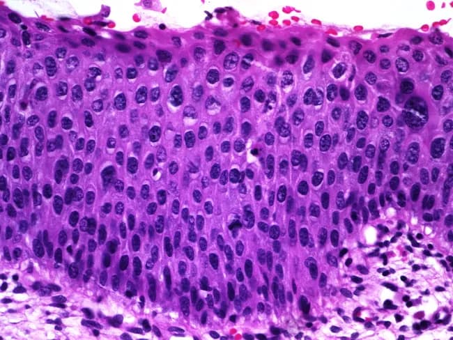 Histology image of mucosal epithelium showing features of squamous epithelial dysplasia on light microscopy. Prepared as a paraffin-embedded hematoxylin and eosin (H&E) stained section and viewed under brightfield microscopy at high magnification (~400x). The epithelium is stratified, with orderly basal cell layer but marked nuclear atypia throughout the lower and mid portions. Nuclear enlargement and hyperchromasia are evident, along with variation in nuclear size (anisokaryosis) and coarse, clumped chromatin. There is partial maturation at the superficial aspect, with surface layer showing more differentiated cells, suggesting some preserved maturation toward the lumen. Occasional mitotic figures are observed in the lower half of the epithelium, indicative of increased proliferative activity. Overall architecture reveals thickened epithelium (acanthosis) with preserved polarity in some cells but dysplastic changes in others. No invasion is evident in this field, though the mitotic activity and cytologic atypia raise concern for preinvasive squamous intraepithelial lesion. The imaging is relevant for diagnosis of epithelial dysplasia or squamous intraepithelial lesion and has clinical significance for risk stratification, biopsy correlation, and surveillance. Potential clinical applications include screening for precancerous lesions in mucosal surfaces, monitoring response to therapy, and educational demonstration of dysplastic cytology for medical students and residents.