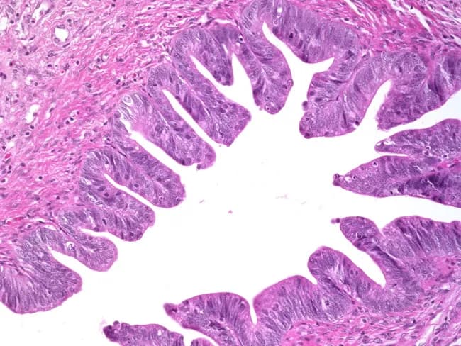 Histopathology, Light microscopy, H&E stained cervical tissue, high-power view. The specimen is a cone biopsy from the cervix containing endocervical glandular epithelium exhibiting adenocarcinoma in situ (AIS) characterized by neoplastic cells lining proliferative glandular papillae, with marked cytologic atypia and frequent apoptotic bodies. The architectural pattern shows slender, arborizing papillary fronds with glandular back-to-back arrangement but without destructive invasion into the stroma. Notable features include nuclear enlargement, hyperchromasia, along with stratified epithelium and mitotic activity confined to the epithelium. In addition, there is an associated squamous intraepithelial lesion (CIN) coexisting with AIS, reflecting multi-lineage cervical neoplasia in a single specimen. The differential diagnosis includes invasive adenocarcinoma, in situ adenocarcinoma with gland crowding, and high-grade CIN with gland involvement; however, stromal invasion is not evident. Clinical significance: AIS with concurrent CIN carries risk of multifocal disease and progression; cone biopsy margins are prognostically important, and negative margins do not eliminate recurrence risk, requiring close follow-up and possibly additional treatment. This image is relevant for pathology education, cervical cancer screening, colposcopy correlation, and research on neoplastic progression in cervical epithelium. Clinical implications include assessing margins, staging risk, guiding surveillance intervals, and discussing fertility-sparing options when appropriate. Educational value for residents and fellows.
