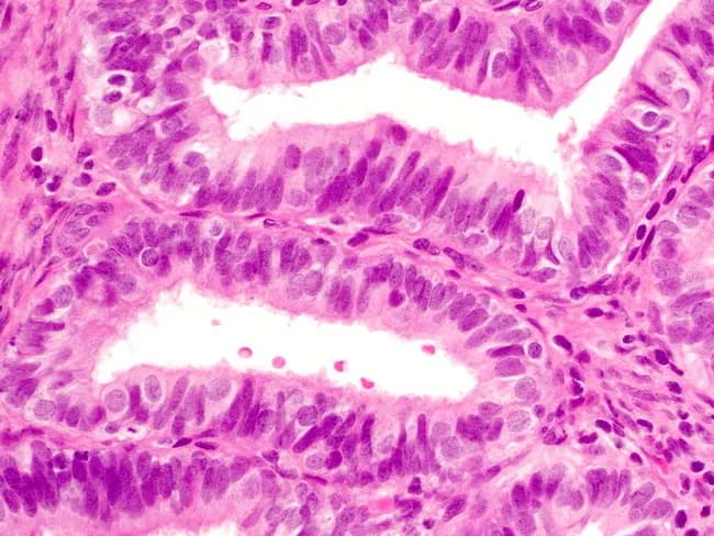 Imaging modality: bright-field light microscopy of a hematoxylin and eosin (H&E) stained endometrial tissue section from a biopsy. The tissue demonstrates nonatypical endometrial hyperplasia with crowding and architectural complexity of glands. The glands are lined predominantly by ciliated columnar epithelial cells with eosinophilic cytoplasm, showing typical tubal-type epithelium within the endometrium. Interspersed among the ciliated cells are round, clear cells consistent with tubal metaplasia. The stromal background is preserved, with no conspicuous cellular atypia or high-grade mitotic activity. The glands exhibit variable diameter and branching, yet maintain orderly polarity without cribriform destruction. Overall histology indicates benign metaplastic transformation rather than malignant invasion, and there is no definite cytologic atypia to suggest endometrial intraepithelial neoplasia or carcinoma. Recognizing tubal metaplasia in this setting is critical to avoid misinterpretation as serous or endometrioid carcinoma and to distinguish it from reactive or hormonal changes. Clinically, the finding may reflect underlying hormonal influences or sampling artifact; management decisions should integrate morphology with patient age and risk factors. This description supports educational use, differential diagnostic discussions, and research on endometrial metaplasia patterns in hyperplastic endometrium. The image thereby serves as a teaching exemplar for distinguishing benign tubal metaplasia from malignant glandular processes in endometrial pathology.