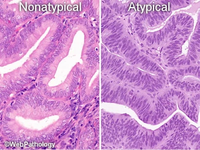 This is a paired histopathology image of endometrium illustrating the 2014 World Health Organization (WHO) revision to a two-tiered classification of endometrial hyperplasia (EH): nonatypical EH (benign hyperplasia) on the left and atypical EH/EIN on the right. The left panel displays simple to moderately complex glandular architecture with mild or absent cytologic atypia, lined by columnar epithelium and relatively orderly nuclear orientation, consistent with benign reactive changes due to unopposed estrogen. The right panel demonstrates marked architectural complexity with back-to-back crowded glands and pronounced cytologic atypia, including nuclear enlargement, loss of polarity, prominent nucleoli, and stratification, compatible with atypical EH and endometrioid intraepithelial neoplasia (EIN). The textural differences reflect a histologic continuum from nonatypical EH to clonal premalignant lesions. This classification emphasizes molecular alterations such as PTEN, PAX2, KRAS mutations, and microsatellite instability associated with EIN, and correlates with clinical risk of progression to endometrial adenocarcinoma (≈<2% for nonatypical EH versus ~25–30% for atypical EH/EIN if untreated). Clinically, this distinction guides management decisions, surveillance, and potential hormonal versus surgical therapy. The image underscores the transition from benign hyperplasia to a premalignant/neoplastic process, highlighting the diagnostic significance of cytologic atypia and glandular architecture in endometrial pathology.