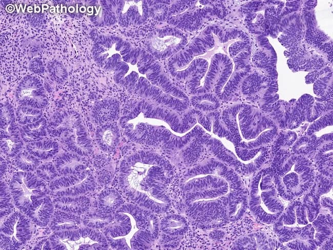 Histopathology of an endometrial biopsy showing atypical hyperplasia/endometrioid intraepithelial neoplasia (AEH/EIN). The section demonstrates endometrial glands arranged in a back-to-back, crowded pattern with minimal intervening stroma, resulting in a gland-to-stroma ratio greater than one. Glandular profiles are round to tubular or exhibit complex, stellate, or irregular contours with branching and occasional outpouchings. Cytologic atypia is evident by enlarged, round to elongated nuclei with increased nuclear-to-cytoplasmic ratio, loss of nuclear polarity, irregular nuclear distribution, and, in some glands, conspicuous nucleoli. Mitotic activity is variably increased, reflecting proliferative potential. Notably, metaplastic changes are present in several glands, including squamous, tubal, secretory, eosinophilic, mucinous, or papillary phenotypes, which can complicate interpretation. The background stroma remains relatively scant, supporting a diagnosis of AEH/EIN rather than benign proliferative processes. Clinically, this lesion is considered a precursor to endometrioid carcinoma and carries an elevated risk of concurrent carcinoma; thus, accurate grading and thorough sampling are essential. This histologic pattern is typically identified on formalin-fixed, paraffin-embedded H&E-stained sections examined under light microscopy at variable magnifications (low-power architecture and high-power cytology). Relevance spans diagnostic pathology, gynecologic oncology, and research on endometrial carcinogenesis; implications include risk stratification and guiding management (surgical or conservative) and surveillance.