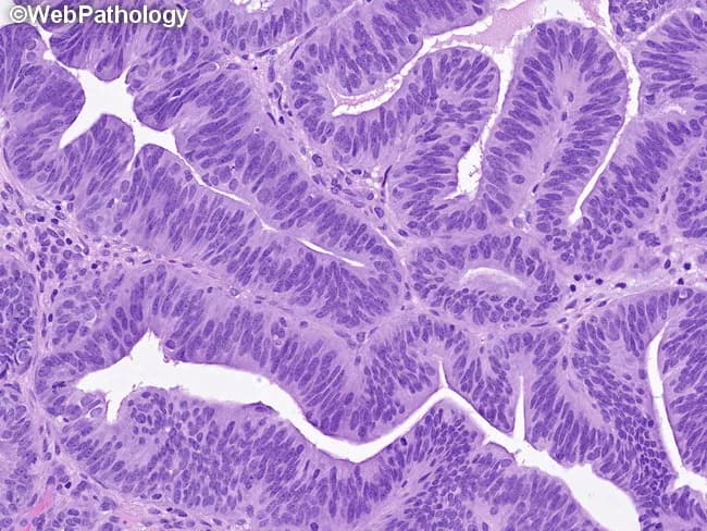 This is a histopathology image of endometrial tissue stained with hematoxylin and eosin. The section shows endometrial glands embedded in scant stroma with a marked gland crowding characteristic of atypical hyperplasia/endometrioid intraepithelial neoplasia (AEH/EIN). The glands are arranged back-to-back, with gland-to-stroma ratio greater than 1, and display rounded, tubular, or complex, stellate profiles with branching and occasional outpouchings. Epithelial cells demonstrate cytologic atypia, including enlarged nuclei, elevated nuclear-to-cytoplasmic ratio, loss of polarity, and irregular nuclear distribution; nucleoli may be distinct in some areas. Mitotic figures are variably increased, reflecting proliferative activity. Some cases show metaplastic changes such as squamous, tubal-type, secretory, eosinophilic, mucinous, or papillary differentiation, which can complicate interpretation. The image highlights the diagnostic challenge of distinguishing AEH/EIN from benign hyperplasia or early endometrial carcinoma. Clinically, AEH/EIN denotes a premalignant lesion with heightened risk of progression to endometrioid carcinoma and potential for synchronous endometrial neoplasia. This morphologic pattern informs risk stratification and management decisions, including conservative progestin therapy in select patients or definitive surgical treatment in others. In educational and research contexts, this image illustrates diagnostic criteria, histologic criteria, and the importance of integrating architecture, cytology, and metaplasia in endometrial neoplasia assessment.