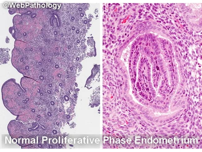 Histology image illustrating the endometrium in two complementary views. The left panel depicts normal proliferative phase endometrium with relatively sparse glands embedded in a cellular stroma, producing a low gland-to-stroma ratio and open gland spacing. The right panel shows characteristic epithelial morphology from proliferative endometrium with elongated, back-to-back glands and prominent, basally oriented nuclei at high power. The specimen emphasizes normal architectural patterns and avoids overcalling hyperplasia when glands are well separated or when fragmentation and telescoping create artifactual crowding. Key differential considerations include endometrial hyperplasia (EH) with or without atypia, disordered proliferative endometrium, reparative or regenerative changes, and endocervical/metaplastic proliferations. Within EH, nonatypical EH must be distinguished from atypical endometrial hyperplasia/endometrioid intraepithelial neoplasia (AEH/EIN), and AEH/EIN must be differentiated from endometrioid carcinoma and from endocervical lesions. Normal proliferative glands show minimal cytologic atypia, whereas AEH/EIN demonstrates architectural complexity (crumpled, crowded glands) and cytologic atypia. Artifacts such as glandular fragmentation, fragmentation- or telescoping-related crowding, and sample artifact can mimic AEH/EIN if the specimen is not intact. This image supports educational differentiation for gynecologic pathology, endometrial biopsy interpretation, and clinical correlation with bleeding patterns and imaging findings. Keywords: endometrium, proliferative phase, hyperplasia, AEH, EIN, histology, biopsy, gland-stroma ratio, artifacts, differential diagnosis teaching.