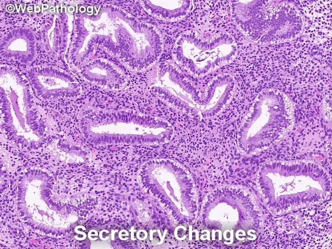 Endometrial histology in secretory phase demonstrated by light microscopy on a hematoxylin and eosin stained endometrial biopsy specimen. Glandular architecture shows irregular serration with gland crowding in focal areas, while glands are lined by tall, columnar secretory epithelium. Nuclei are enlarged and may display mild pleomorphism and loss of polarity, consistent with secretory transformation. The background stroma is edematous and commonly predecidualized, with cytoplasmic vacuolization of stromal cells. Together, these findings reflect physiologic secretory changes rather than overt endometrial hyperplasia. Notably, secretory endometrium can mimic endometrial hyperplasia/endometrioid intraepithelial neoplasia (EIN) in some cases, but the absence of marked architectural crowding, complex glandular patterns, or cytologic atypia argues against a neoplastic process. Differential considerations include secretory change, simple endometrial hyperplasia without atypia, and EIN in a background of secretory endometrium; careful architectural assessment and clinical correlation are essential. Diagnostic significance lies in distinguishing benign secretory transformation from premalignant or malignant entities to avoid overtreatment. This image is educational for pathology training, differential diagnosis exercises, and research on endometrial cycle pathology. Correlate with patient menstrual history, pregnancy status, and cycle timing; repeat sampling or adjunct studies may be warranted when discordance is suspected. Interpret interpretation should integrate histology with clinical data and follow-up.
