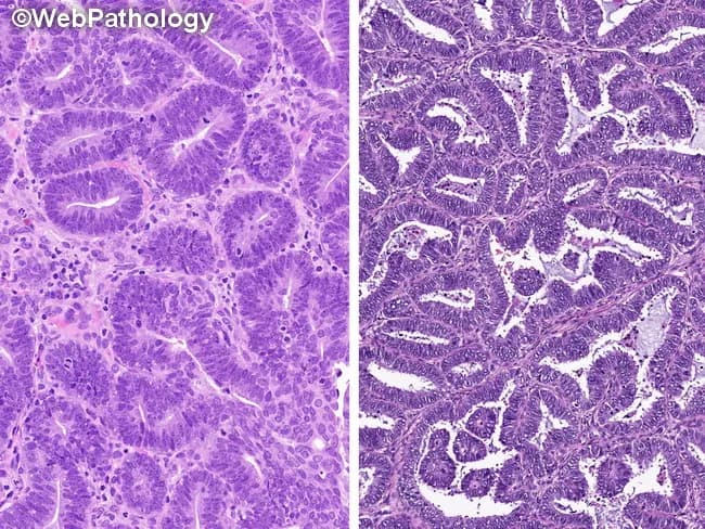 This is a paired histopathology image of endometrial neoplasia stained with hematoxylin and eosin. The left panel highlights atypical endometrial hyperplasia/endometrial intraepithelial neoplasia (AEH/EIN), showing glandular crowding, complex architecture, pseudostratified or stratified nuclei, and prominent cytologic atypia confined to the epithelium with preserved stroma. The right panel shows a well-differentiated endometrioid adenocarcinoma, with confluent back-to-back glands, solid sheets, cribriform and maze-like growth, and more marked cytologic atypia; a desmoplastic stromal response may be evident adjacent to malignant glands. Architectural patterns such as villoglandular, papillary, or microacinar arrangements can appear in either lesion but are more characteristic of carcinoma in this context. Necrosis and foamy macrophages may be present in carcinoma areas. Distinguishing AEH/EIN from carcinoma on limited biopsy can be challenging due to overlapping features and fragmentary material. Diagnostic thresholds cited by experts include gland size and extent (often >2 mm) and the presence of infiltrative or confluent growth with reduced stromal support. When features are intermediate, terminology such as atypical hyperplasia cannot rule out well-differentiated carcinoma or AEH/EIN bordering on well-differentiated carcinoma may be reported. This image emphasizes the spectrum and informs clinical decision making regarding surveillance, medical therapy, and surgical management.