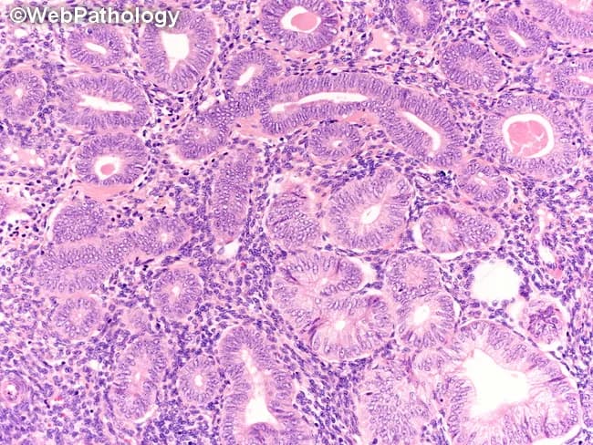High-resolution hematoxylin and eosin stained endometrial biopsy reveals nonatypical endometrial hyperplasia (NEH). The histology shows proliferative-type glands that are simple to mildly irregular and tightly packed, with a gland to stroma ratio greater than one. Gland architecture is predominantly tubular, with minimal branching and without complex cribriform patterns. The glandular epithelium is lined by pseudostratified columnar cells showing uniform nuclei without marked pleomorphism. Cytologic atypia is absent or very subtle, with no conspicuous nuclear enlargement, hyperchromasia, or prominent nucleoli. The surrounding stroma is fibrous and moderately edematous, enriched with scattered lymphocytes, without desmoplastic reaction. Overall, the glandular proliferation mimics a proliferative endometrium but with increased density and crowding appropriate for NEH. No stromal invasion or myometrial involvement is evident in this section. The image highlights hallmark NEH features: gland crowding, preserved maturation, lack of cytologic atypia, and a relatively benign architectural pattern. Clinically relevant distinctions include differentiation from endometrial hyperplasia with atypia and endometrial carcinoma, which carry higher malignant risk and require different management. This image, attributed to WebPathology, serves as an educational reference for pathologists and trainees to recognize NEH morphology and to support differential diagnosis in gynecologic pathology exams and clinical practice. Used for teaching and diagnostic guidance.