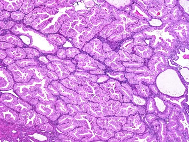 This histology image demonstrates an endometrial glandular neoplasm with well-differentiated, elongated, angulated, and branching glands embedded in a scant stroma. The glandular architecture is predominantly back-to-back, with occasional cribriform-like contours and minimal intervening cytoplasm, consistent with endometrioid histology. Cytologic atypia is mild, featuring uniform nuclei and rare mitotic figures, indicating a low-grade phenotype. The lesion contains a small solid component, described as less than or equal to 5% of tumor volume, which supports a FIGO Grade 1 classification for endometrial adenocarcinoma. The specimen originates from a formalin-fixed paraffin-embedded tissue section, stained with Hematoxylin and Eosin for routine morphologic assessment, and evaluated under bright-field microscopy. Clinically, FIGO Grade 1 endometrioid adenocarcinoma is associated with a relatively favorable prognosis compared with higher-grade counterparts, though invasion depth and myometrial involvement critically influence staging and treatment planning. Diagnostic significance centers on accurate grading, as it guides surgical management and adjuvant therapy decisions. Differential considerations include benign proliferative endometrium, endometrial hyperplasia with atypia, higher-grade endometrioid carcinomas, and serous-endometrial carcinoma. This image is valuable for gynecologic oncology education, pathology training, and research in endometrial carcinogenesis, pattern recognition, and grading criteria. This descriptive caption supports digital teaching libraries, case reviews, and AI-assisted pattern analysis in oncology education.
