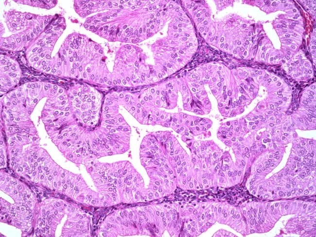 A high-magnification hematoxylin and eosin-stained histopathology image of endometrial tissue showing a well-differentiated endometrioid adenocarcinoma. Glandular architecture dominates with tubule-forming glands that resemble normal endometrium but exhibit mild cytologic atypia, including uniform nuclei and minimal pleomorphism. The tumor displays a low-grade pattern with limited solid growth, consistent with FIGO grade 1 endometrioid carcinoma; however, grading can be influenced by cytologic atypia and the relative proportion of solid components. Notable considerations include ensuring exclusion of high-grade serous carcinoma, which would require different architectural and nuclear features. The finding has significant diagnostic and clinical implications: prognosis is generally favorable for low-grade, well-differentiated lesions when confined to the uterus, but deeper myometrial invasion, lymphovascular invasion, or higher grade would alter management and adjuvant therapy. In practice, pathologists assess the balance between glandular differentiation and cytologic atypia to assign FIGO grade, with grade 2 arising if a tumor with predominant architectural pattern grade 1 shows severe atypia. Differential diagnoses include benign mimics and other endometrial carcinomas; correlation with clinical data and ancillary studies may be necessary for definitive classification. Contextual notes may include imaging findings, hormone receptor status, and molecular profiling if required for treatment planning and prognosis. These data can influence eligibility for targeted therapies and clinical trials.