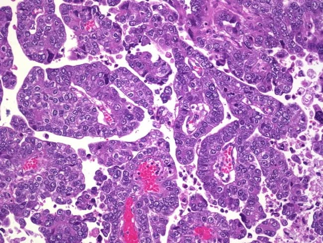 Imaging modality: Histopathology, prepared as a hematoxylin and eosin stained section of uterine endometrium. The slide demonstrates papillary clusters of malignant epithelial cells forming intricate papillary fronds with fibrovascular cores. Cells show high-grade nuclear atypia, marked pleomorphism, conspicuous nucleoli, and brisk mitotic activity with frequent mitotic figures. Necrosis is evident in several regions. Psammoma bodies are present as concentric calcified cores within papillary structures. Notably, there is invasion into the myometrium, indicating an infiltrative growth pattern and depth of invasion that carries prognostic and staging implications (FIGO staging for endometrial carcinoma). The architecture is complex and papillary, rather than glandular, favoring serous-type histology; psammoma bodies and high-grade features strongly support serous endometrial carcinoma over endometrioid types. Inflammatory cells and stromal desmoplasia may be variably present. This histology correlates with aggressive behavior, propensity for lymphovascular invasion, and higher likelihood of extra-uterine spread. Clinically, this morphology aligns with postmenopausal bleeding in many cases and requires staging workup, including surgical intervention with lymph node assessment and consideration of adjuvant therapy (carboplatin/paclitaxel +/- radiation). Differential considerations include clear cell carcinoma and metastatic ovarian serous carcinoma to the endometrium. Accurate pathologic subtyping is critical for prognosis and treatment planning. This description enhances searchability and education.