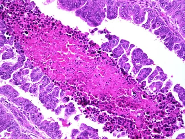 This is a histopathology image of endometrial tissue demonstrating papillary serous carcinoma, a high‑grade variant of endometrial cancer. The specimen shows endometrial glandular epithelium with papillary fronds and a conspicuous papillary architecture with fibrovascular cores, lined by markedly atypical serous carcinoma cells. Nuclear features include marked pleomorphism, enlarged nuclei, conspicuous nucleoli, increased mitotic activity, and frequent apoptotic bodies. A focal necrotic zone is present within the tumor epithelium, with eosinophilic debris and ghost outlines at the base. The lesion often recapitulates serous histology seen in ovarian or fallopian tube serous carcinomas and may coexists with background atrophic or proliferative endometrium. Psammoma bodies may be present. The image demonstrates high‑grade cytology, with p53‑altered phenotype on immunohistochemistry (not shown here), and aggressive behavior with early invasion into the myometrium. Clinical context links to prior pelvic radiation for cervical cancer, long‑term tamoxifen exposure, BRCA1 mutation, and breast carcinoma. Pathologic diagnosis correlates with history and confirms endometrial serous carcinoma with necrosis focus; prognosis is poorer than endometrioid types, requiring comprehensive surgical staging, adjuvant chemotherapy, radiotherapy, and molecular profiling for targeted therapy considerations. This histology image is educational for gynecologic oncology, pathology residents, and medical students. Useful for differential diagnosis and prognosis discussions.