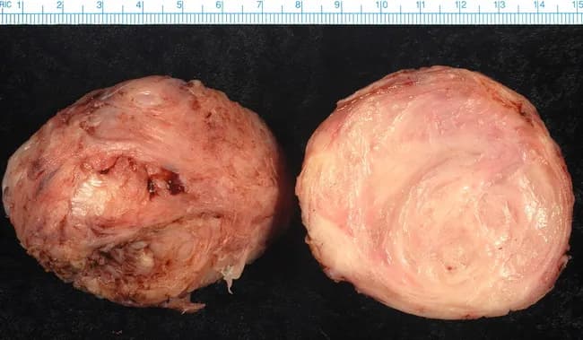 This gross pathology image shows a uterine leiomyoma (fibroid), the most common benign neoplasm of the female uterus. The specimen consists of a well-circumscribed, bulging mass with a firm, rubbery consistency. The right-hand section reveals the classic whorled tan-to-white cut surface produced by intersecting bundles of smooth muscle fibers. Degenerative changes, such as hyaline degeneration, may alter color and texture and can complicate gross evaluation. The lesion is intramural, typically arising within the myometrium and may be solitary or multiple in the uterus, sometimes enlarging the organ and producing bulk symptoms. Although histologic subtypes exist, all leiomyomas share a similar gross appearance, making differentiation from other myometial lesions primarily dependent on histology. This image is useful for gross-pathology education, surgical pathology review, and gynecologic oncology reference, illustrating tumor organization, texture, and surface characteristics. Clinically, fibroids are common in middle-aged women and can be detected by pelvic examination and imaging (ultrasound, MRI). Management depends on size, location, symptoms, and patient preference, ranging from expectant management to myomectomy or hysterectomy. The image provides context for teaching gross anatomic features, differential diagnoses, and the relevance of degenerative changes in leiomyomas. This context supports educational use in pathology laboratories and clinical rounds for learners.