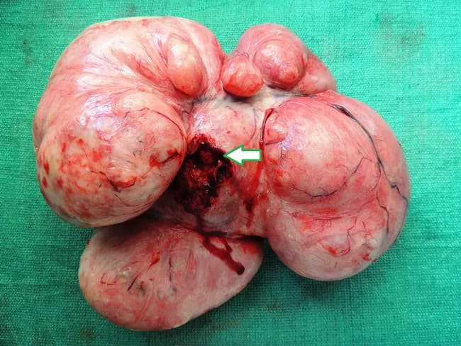 This is a gross pathology photograph of a giant uterine leiomyoma (fibroid) arising from the uterus, with a thick pedicle anchored to the right uterine cornual region. Imaging modality was not used for this capture; the image represents intraoperative gross anatomy of a large subserosal mass extending into the pelvic and abdominal cavities. The mass measures approximately 36 x 34 x 30 cm and weighs about 9.8 kg. On cut surface, the specimen shows a predominantly fleshy, whorled appearance with focal cystic degeneration containing serous fluid, and a pale, firm capsule surrounding lobulated nodules. The external surface is smooth to lobulated, with some congestion and serosal adherence. Histologically, samples show classical benign smooth muscle fibers arranged in intersecting fascicles (leiomyomatous tumor) with hyaline degeneration; no overt atypia or high mitotic activity is evident. Clinically, giant subserosal fibroids can mimic ovarian neoplasms and cause mass effect including abdominal distension and urinary frequency. Diagnostic significance lies in distinguishing benign leiomyoma from malignant sarcoma or ovarian malignancy; intraoperative frozen section can aid immediate surgical decision-making. Differential diagnoses include ovarian fibroma/thecoma, serous cystadenoma, broad ligament fibroid, or pedunculated ovarian tumor. This image is relevant for education on gynecologic pathology, surgical anatomy, and gross morphologic features of giant fibroids.