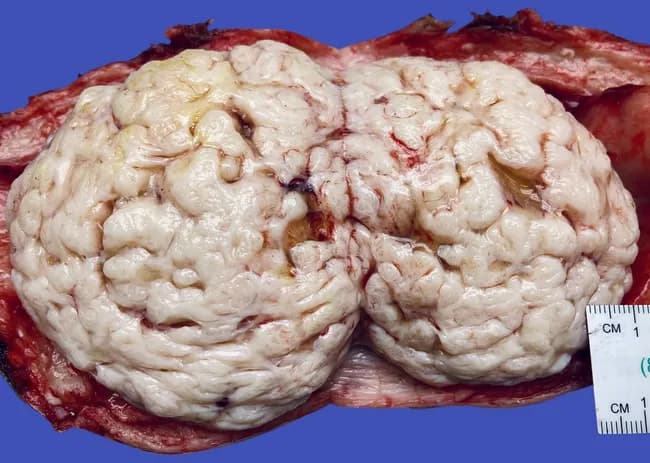 This gross pathology photograph depicts a uterus with a large intramural leiomyoma (uterine fibroid). The specimen shows a firm, well-circumscribed mass within the myometrium, with a cerebriform, gyriform cut surface produced by densely packed smooth muscle bundles arranged in a whorled pattern. The cut surface exhibits pale, whitish zones with convoluted ridges reminiscent of brain gyri, a characteristic gross feature described as cerebriform. The mass is pale to pale-tan with a slightly gleaming surface; surface vascularity is accentuated by incidental small hemorrhages at the periphery. The uterus is opened to expose the lesion, with the surrounding myometrium appearing bulky but without obvious invasion into adjacent tissue. The lesion is typically encapsulated by a fibrous capsule and shows no necrosis or overt malignant features on gross examination. The morphology is consistent with a benign smooth muscle tumor (leiomyoma), and the cerebriform cut surface is a recognized gross variant. Diagnostic significance: gross examination supports benign etiology and helps distinguish fibroids from malignant leiomyosarcoma, though histology is required for confirmation. Clinical correlation: fibroids are common in reproductive-age women and may cause menorrhagia, pelvic pressure, or infertility; management includes myomectomy or hysterectomy; imaging (ultrasound, MRI) often complements gross findings. Useful for education and research.