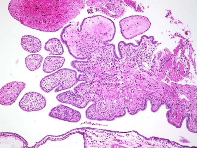 Imaging modality: Histology (Light microscopy) of uterine tissue section stained with Hematoxylin and Eosin. Specimen: uterine lesion in a paraffin-embedded tissue block; section thickness 4–5 μm; magnification range from 4x to 40x to evaluate architecture and cytology. Location: uterus, involving endometrium with adjacent fibromatous stroma; papillary fronds project into glandular spaces; stalks are sessile or papillary; epithelium is endometrioid, endocervical, or tubal type and shows no cytologic atypia. Tumor architecture is predominantly benign with fibromatous stroma supporting papillary fronds, consistent with adenofibroma. Rarely, ducts or glands may harbor foci of adenocarcinoma; presence of malignancy should be carefully assessed for invasion versus incidental focal carcinoma. Myometrial invasion is not a prominent feature in classic adenofibroma. Immunohistochemistry is not routinely required but can aid in differential diagnosis (estrogen/progesterone receptor positivity in glandular epithelium; stromal markers). Clinical relevance: benign neoplasm most often seen in postmenopausal women presenting with abnormal uterine bleeding; critical to distinguish from endometrial adenocarcinoma and atypical polypoid adenomyoma. Ethical considerations: ensure accurate reporting to prevent overtreatment. Use: educational reference for gynecologic pathology; supports differential diagnosis and surgical decision-making. This description emphasizes tissue architecture, epithelial lineage, and stromal context essential for accurate grading, prognosis, and patient management decisions overall.