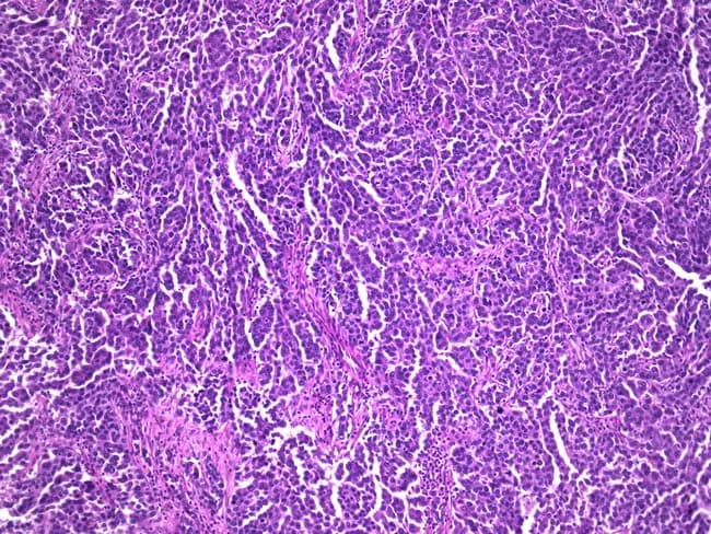 Histopathology examination of fallopian tube tissue demonstrating serous carcinoma. Imaging modality: Histopathology with light microscopy, hematoxylin and eosin (H&E) stained section. Primary site: fallopian tube (oviduct); tubal mucosa involved with neoplastic epithelium. Anatomical context: female reproductive tract, adnexal region; left or right not specified. Visual features: densely packed neoplastic cells forming papillary, cribriform, and glandular patterns with complex architecture; high-grade nuclear atypia, marked pleomorphism, conspicuous nucleoli; abundant mitotic figures; invasion into the underlying stroma; rare psammoma bodies may be observed. Diagnostic categorization: high-grade serous carcinoma of tubal origin (serous carcinoma); consistent with 70% of tubal malignancies. Immunophenotype often shows WT1 positivity in routine practice (not visible in image). Clinical significance: tubal origin serous carcinomas are associated with concurrent ovarian and endometrial malignancies, BRCA mutations, and heightened risk for breast cancer. Differential considerations include metastatic serous carcinoma from ovary or peritoneum; tubal intraepithelial carcinoma (STIC) precursor; endometrioid carcinoma in related contexts. Clinical relevance: histology supports staging and management decisions, including surgical cytoreduction and adjuvant therapy; informs genetic counseling and surveillance for patients and at-risk relatives. Use cases: educational histology references; diagnostic atlases; research on tubal carcinogenesis and BRCA-associated cancers.