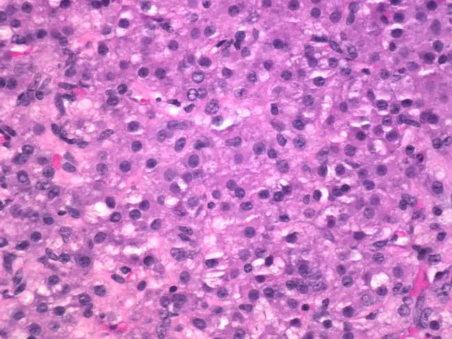 This is a light microscopy image of ovarian tissue, prepared as an H&E-stained section, viewed at high magnification (approximately 400x). The field demonstrates a population of theca-lutein–type cells contiguous within stromal background. The cells are polygonal with abundant eosinophilic cytoplasm and centrally located, round to oval nuclei, with conspicuous nucleoli. Nuclear features include mild pleomorphism and occasional mitotic figures, consistent with steroid-secreting histology rather than a high-grade carcinoma. The cells are arranged in cords and small nests within stromal background; there is no overt necrosis or extensive hemorrhage evident in this field. Background appears relatively uniform with small, occasional intercellular lipid vacuoles not clearly defined. The histologic pattern is compatible with a theca-lutein phenotype commonly seen in luteinized granulosa/theca cell populations; in isolation these features may reflect luteinization associated with corpus luteum formation or hormonal stimulation. Differential diagnoses include thecoma, granulosa cell tumor, steroid cell tumor, Sertoli-Leydig cell tumor, or fibroma-thecoma continuum. Clinically, this morphology is relevant for estrogenic activity or androgenic effects depending on tumor burden and endocrine status. Correlation with patient age, clinical presentation, serum hormone levels, and imaging is advised to establish a precise diagnosis and guide management.