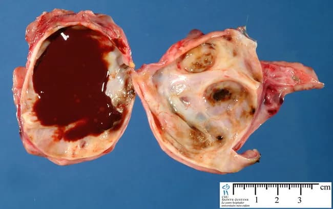Gross pathology photograph of bilateral ovarian tissue after surgical excision, illustrating ovarian endometriomas (Chocolate cysts). The image presents two right- and left-ovary specimens opened to reveal cystic cavities filled with dark brown, viscous chocolate-colored fluid consistent with longstanding hemorrhagic content. The cyst walls are thickened and fibrous, with irregular surfaces and focal adhesions typical of endometriotic implants. The left ovary shows a large unilocular cavity with richly pigmented brown contents; the right ovary displays multiple smaller cystic spaces and mural nodularity. A centimeter-scale ruler is included for size reference (approximately several centimeters in diameter). The surrounding stroma is pale to pink-tan, with areas of adhesion. These gross features correspond to endometriosis involving the ovary, producing endometriomas. Such lesions arise from ectopic endometrial tissue projecting into the ovarian cortex, leading to recurrent cyclic hemorrhage and cyst formation. Clinically, endometriomas are associated with pelvic pain, dysmenorrhea, and infertility. Pathology confirms diagnosis when histology reveals endometrial glands and stroma within the cyst wall (though not shown in this gross image). Diagnostic significance lies in confirming ovarian involvement by endometriosis, guiding surgical management, and informing prognosis and recurrence risk. Use cases include medical education, radiology-pathology correlation, and gynecologic oncology review. Additional histology correlation recommended.
