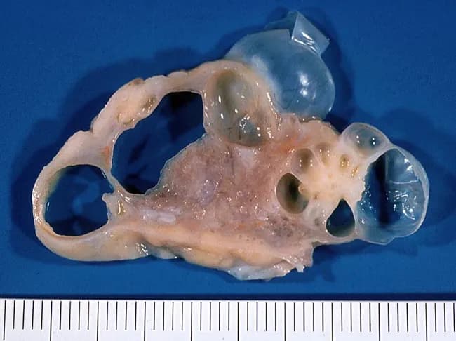 This is a gross pathology photograph of an ovarian tumor. The specimen represents a unilateral ovarian mass with multilocular cystic architecture. The internal content consists of clear, colorless serous fluid within multiple thin-walled cysts. The cyst walls are smooth and translucent, without obvious mural nodules or solid components on gross examination. The external surface is pale, smooth, and without frank hemorrhage or necrosis. The overall appearance is consistent with a benign serous cystadenoma of ovarian origin. The lesion is located in the pelvis, arising from the ovarian surface or cortical epithelium, and demonstrates a predominately cystic, noninfiltrative growth pattern. The patient is a 38-year-old female; serous cystadenomas are common epithelial ovarian neoplasms and typically present as enlarging adnexal masses or incidental findings. Diagnostic significance: gross features favor a benign process, but histopathologic confirmation is essential to exclude serous cystadenocarcinoma or mucinous variants. Differential considerations include mucinous cystadenoma/cystadenocarcinoma, serous borderline tumors, and paraovarian cysts. Clinical correlation: complete surgical excision with intact capsule provides definitive treatment and favorable prognosis. Potential clinical use cases: educational reference for ovarian tumor morphology, gross-pathology catalogs, radiologic-pathologic correlation studies, and machine learning datasets for ovarian neoplasms. This image supports differential diagnosis and educational training in gynecologic pathology.