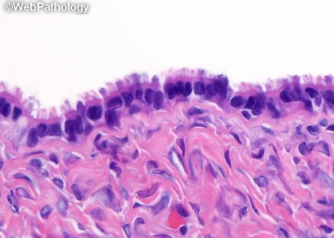 High magnification light microscopy of a serous ovarian cystadenoma. Tissue was formalin-fixed, paraffin-embedded and stained with hematoxylin and eosin. The lesion arises in the ovary as a thin-walled, unilocular cyst with an epithelial lining of tubal-type mucus secreting epithelium. The lining shows a single layer of ciliated cuboidal to columnar cells with preserved polarity; cilia are clearly visible. Hobnail cells may be present in focal areas. The lamina propria contains variable fibrous (spindle) stroma supporting the epithelium. Papillary projections may be seen on the cyst surface, but these papillae are lined by the same single epithelium and lack architectural complexity or invasion. Cytologic atypia is not evident. Psammoma bodies appear in about 30% of cases, seen as concentrically laminated calcified bodies within papillary cores or stromal niches. Overall, the morphology is benign-appearing, with no evidence of invasion or high-grade cytologic features. The combination of tubal-type epithelium, ciliation, hobnail cells, papillary components, psammoma bodies, and noninvasive behavior supports a diagnosis of benign serous cystadenoma. Clinically, this tumor carries an excellent prognosis following surgical excision; differential considerations include serous borderline tumor and serous cystadenocarcinoma. This histology image exemplifies classic serous morphology and provides teaching material for ovarian tumor identification and pathology review.