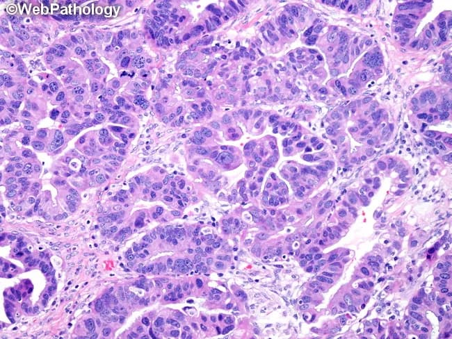 Histopathology image of ovarian high-grade serous carcinoma (HGSC) captured on light microscopy after formalin fixation and hematoxylin and eosin staining. The specimen is ovarian/tumor tissue. The tumor demonstrates complex gland-like spaces lined by markedly atypical, high-grade serous epithelial cells with pleomorphic hyperchromatic nuclei and conspicuous nucleoli. Architectural pattern is predominantly papillary with focal glandular and cribriform areas; other patterns such as cystic, microcystic, and solid components can be present in HGSC and may be observed in the same lesion. The observed glands are densely cellular, with loss of polarity, prominent mitotic activity, and frequent apoptotic figures. The stroma shows desmoplasia and invasion by tumor glands, supporting malignancy. Overall features are typical for high-grade serous carcinoma of the ovary, with aggressive cytology and high-grade nuclei. This histology is critical for differentiating HGSC from lower-grade serous tumors and other ovarian carcinoma subtypes, guiding staging, prognosis, and platinum-based chemotherapy responsiveness. Clinically, HGSCs often present with advanced-stage disease and elevated CA-125. This image provides educational demonstration of serous differentiation, papillary architecture, and invasive gland formation, illustrating key criteria used in diagnostic pathology reports, tumor grading (grade 3), and differential diagnosis including endometrioid, mucinous, and clear cell ovarian carcinomas.