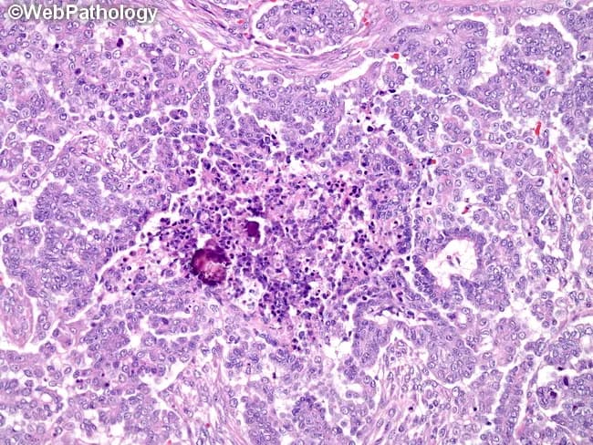 Histology: High-grade serous carcinoma of the ovary is illustrated on hematoxylin and eosin stained paraffin sections prepared for light microscopy. The specimen comprises ovarian/adnexal tissue with intricate papillary and glandular architectures embedded in delicate fibrous stroma. Tumor epithelium demonstrates marked nuclear pleomorphism, conspicuous nucleoli, and high mitotic activity, consistent with high-grade serous morphology. Notably, numerous calcified psammoma bodies are scattered within tumor clusters and in a focal necrotic center, reflecting degenerative change. The papillary fronds display hierarchical branching with complex invaginations into fibrous stroma, and tumor cells line papillary cores, forming psammoma body–laden aggregates. Necrosis is focal rather than widespread, with surrounding viable tumor showing cohesive cells and prominent cytoplasm. Invasion into adjacent ovarian stroma may be present, and cellular solidity varies among fields. The presence of psammoma bodies is characteristic of serous tumors and has potential prognostic implications; when abundant, they are associated with better differentiation and often improved prognosis, though high-grade serous carcinomas remain clinically aggressive. Immunohistochemical staining patterns, if performed, typically reveal WT1 positivity and p53 overexpression with mutant morphology. Overall, the slide highlights classic serous ovarian carcinoma features—papillary architecture, psammoma bodies, necrosis, nuclear atypia, and high proliferative index compatible with an ovarian-origin malignant neoplasm.
