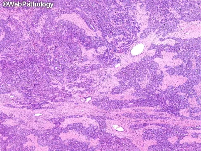 Histopathology slide of an ovarian mass, examined by light microscopy on hematoxylin and eosin (H&E) stained sections. Primary subject: high-grade serous carcinoma of the ovary. Specimen type: ovarian tumor tissue. Imaging perspective: microscopic examination of a formalin-fixed paraffin-embedded section, low to mid magnification. Morphology: tumor shows cohesive solid sheets of malignant epithelial cells with marked nuclear pleomorphism, conspicuous nucleoli, and high mitotic activity. Architectural features include anastomosing trabeculae and glandular/gland-like growth patterns, with occasional slit-like or cribriform glandular arrangements. The neoplasm displays solid, nests, and papillary-like structures embedded in fibrous stroma; tubulocystic differentiation may be evident in focal areas. The overall pattern is characteristic of high-grade serous carcinoma, often accompanied by areas of crush artifact and necrosis. Notable diagnostic features include high-grade cytology, brisk mitotic rate, and complex architectural heterogeneity. Optional ancillary correlation with immunohistochemistry commonly shows p53 abnormal staining and WT1 positivity, supporting serous differentiation. Clinical significance: confirms epithelial ovarian cancer with aggressive phenotype, guiding staging, surgical planning, and platinum-based chemotherapy. Differential considerations include mucinous, endometrioid, clear cell carcinomas, metastatic serous carcinoma, and mixed histology. This image is relevant for educational purposes, pathology teaching, diagnostic practice, and research into ovarian carcinogenesis and targeted therapies.