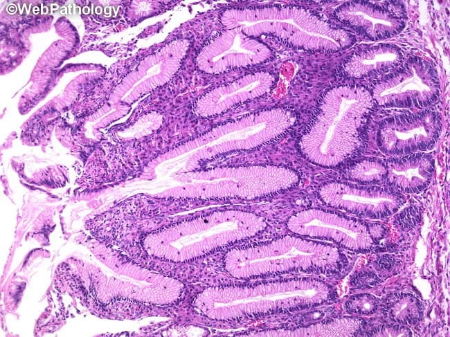 Histopathology of an ovarian mucinous cystadenoma displayed on light microscopy using Hematoxylin and Eosin staining. The specimen comprises cystically dilated mucin-producing glands embedded in fibrous stroma. Lining epithelium is intestinal-type with tall columnar cells and abundant goblet cells, often forming complex glandular and papillary architectures. The glands are typically simple to irregular and may show mucin extravasation into the stroma when cysts rupture; accompanying inflammatory infiltrates and occasional granulomatous stromal response are observed in rupture sites. The mucin-secreting epithelium resembles intestinal mucosa and may mimic endocervical, gastric pyloric, or small intestinal phenotypes. KRAS mutations are reported in a substantial proportion of mucinous ovarian tumors, supporting a primary ovarian origin in many cases. In a minority, mucinous tumors are associated with other ovarian neoplasms, such as dermoid cysts (mature teratoma) or Brenner tumors (~10%). The overall architecture is cystic with papillary projections and glandular folds, lacking stromal invasion in benign mucinous cystadenomas; however, diagnostic vigilance is required to distinguish from mucinous borderline or malignant variants. Clinically, these tumors are typically unilateral and present as large adnexal masses in reproductive-age to middle-aged women; surgical excision is curative when confined to the ovary. Knowledge of KRAS status and mucin morphology aids diagnostic differentiation from metastatic GI primaries.