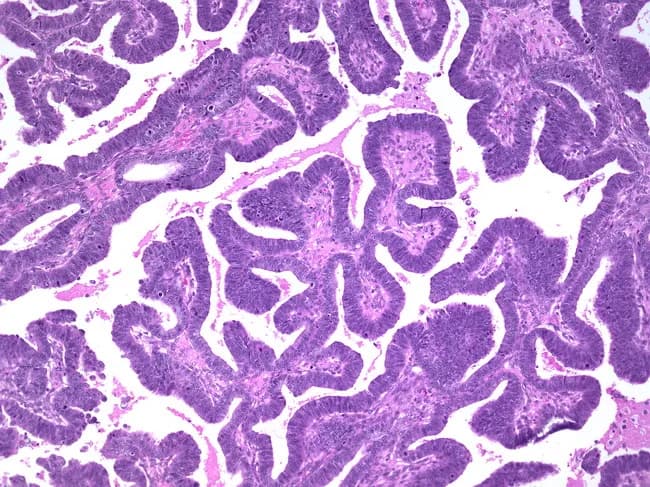 This is a histopathology image (Hematoxylin and Eosin stained) of an ovarian tumor. The specimen is ovarian parenchyma with gland-forming epithelium showing a villoglandular pattern characteristic of endometrioid carcinoma. The glands are lined by stratified columnar epithelium with pale to dark nuclear chromatin, mild to moderate nuclear atypia, and apical cytoplasmic clearing in an overall well-differentiated architecture. The glandular spaces vary in size, with some back-to-back arrangements and occasional cribriform/ villous projections; stromal invasion is suggested by irregular gland termination into surrounding stroma. The histology resembles endometrium (hence endometrioid type) and the tumor constitutes approximately 10-25% of primary ovarian carcinomas, consistent with literature. The differential includes serous, mucinous, clear cell, and metastatic endometrial carcinoma to the ovary; immunohistochemistry and clinical correlation aid in distinguishing these entities. Diagnostic significance: recognition of ovarian endometrioid histology has implications for prognosis and treatment and warrants evaluation for synchronous endometrial pathology. This image is suitable for educational purposes, pathology review, and research on ovarian epithelial tumors, particularly for pattern recognition of villoglandular growth and stratified epithelium. Potential clinical use: differential diagnosis of ovarian neoplasms, surgical planning, grading, and correlation with patient management. Color and morphology of the glands may correlate with imaging features and tumor markers (e.g., CA-125) in clinical practice.