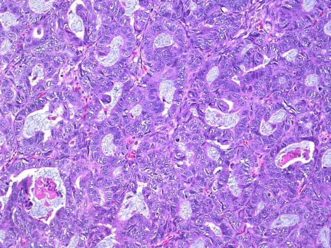 This is a histopathology image (hematoxylin and eosin stained) of an ovarian mass demonstrating a well-differentiated endometrioid carcinoma. The tumor displays tightly packed, back-to-back glands with minimal stroma, lined by neat, pseudostratified columnar epithelium. Nuclei are relatively uniform, with mild to moderate hyperchromasia and rare mitotic figures, consistent with low-grade morphology. The glandular lumina are often crescentic or slit-like; there may be cribriform arrangements in places. Surrounding ovarian stroma shows focal desmoplastic reaction and focal infiltration, supporting invasion by malignant epithelial cells. The tumor shows a predominantly tubular architecture resembling endometrial glands; mucin production is limited. Overall, the morphology fits endometrioid carcinoma of ovarian origin, grade 1. Differential considerations include mucinous or serous type ovarian carcinomas, metastatic endometrial adenocarcinoma, and clear cell carcinoma; however, the glandular pattern, cytologic uniformity, and absence of significant hobnail cells or prominent papillary features favor endometrioid histology. Clinically significant because endometrioid ovarian carcinomas are often associated with endometriosis and may present at an early stage; they may be estrogen-responsive; immunohistochemistry can show PAX8 positivity and variable ER/PR expression. This image is useful for educational teaching, histopathology differential diagnosis, and radiologic-pathologic correlation. Correlation with clinical staging and management is recommended.