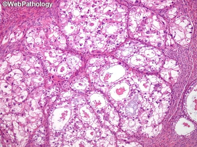 This is a bright-field light microscopy image of an ovarian tumor tissue section stained with Hematoxylin and Eosin. The specimen shows classic histology of ovarian clear cell carcinoma with abundant clear cytoplasm and distinct cell borders. Cells are polygonal and arranged in glandular, tubulocystic, and occasionally solid architectural patterns; hobnail cells with apical nuclei line some gland lumina. The cytoplasm is clear due to glycogen content; PAS-positive and diastase-sensitive. Nuclei are generally central to eccentric, with mild to moderate nuclear atypia and prominent nucleoli in a subset of cells. The tumor demonstrates tubulocystic structures embedded in a fibrous stromal background with delicate microvasculature. Overall distribution is infiltrative, lacking well-defined capsules in this field. There may be areas of microcystic change and focal hobnailing that help distinguish clear cell histology from other ovarian epithelial tumors. The image emphasizes characteristic features: mucin-free clear cytoplasm, glycogen-rich cytoplasm, increased cytoplasmic clearing, and distinct cell borders. Diagnostic significance lies in recognizing the cell morphology and architectural pattern that differentiate clear cell carcinoma from serous or endometrioid subtypes and from metastatic renal cell carcinoma. This morphology has clinical relevance for prognosis and guides platinum-based therapy and surgical management; endometriosis association may be noted in the clinical history.