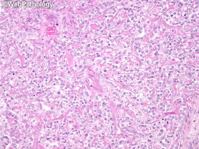 Histology: ovarian clear cell carcinoma, hematoxylin-eosin stained, evaluated at light microscopy. The tissue shows nests and sheets of polygonal cells with distinct cell borders and abundant clear cytoplasm, due to glycogen. Cells are arranged in glandular, tubular or tubulocystic structures; hobnail cells with apically placed nuclei are present, imparting a characteristic appearance. Nuclear enlargement is mild, with minimal pleomorphism; mitotic activity is not appreciably increased. Background stroma is often fibrous; occasional small cystic spaces may be seen. The cytoplasmic clearing is PAS-positive and diastase-sensitive, consistent with glycogen content. Nucleoli are inconspicuous in many cells; cytoplasmic borders crisp. The overall pattern demonstrates a combination of tubulocystic, papillary, and solid growth, which is typical for ovarian CCC. The slide shows features that help distinguish CCC from other ovarian epithelial tumors, such as endometrioid, serous, and mucinous carcinomas. Clinically, ovarian CCC tends to be associated with endometriosis and can show chemoresistance; prognostic implications depend on stage and grade. The presence of hobnail cells is a supportive diagnostic feature. This image likely represents typical example of clear cell histology and may be used for educational purposes to illustrate cellular morphology, glycogen-rich cytoplasm, and glandular architecture in CCC.