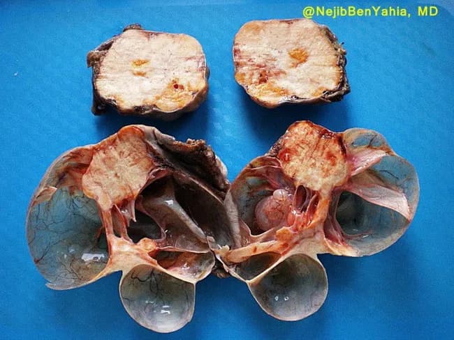 Gross pathology image of bilateral ovarian neoplasms from a surgical resection specimen. The top ovary displays a Brenner tumor with a yellow-white solid cut surface, a feature consistent with fibrous stroma and epithelial nests seen on histology but evident here in gross form. The bottom ovary shows a mucinous cystadenoma manifesting as a multilocular cystic mass with a gleaming, mucoid inner surface. A conspicuous solid yellowish nodule is noted within the mucinous component, adding a focal solid element to the otherwise cystic lesion. The external surfaces show typical ovarian morphology; cross-sectioning reveals distinct tumor components in a single image field, illustrating a concurrent benign Brenner tumor and benign mucinous cystadenoma in two ovaries. This composite ovarian tumor presentation is recognized in gynecologic pathology as an ovarian collision or coexistence of histologically distinct neoplasms, with Brenner tumor arising from transitional-type epithelium in fibrous stroma and mucinous cystadenoma arising from mucinous epithelium. Clinically, these lesions are usually benign; definitive classification requires histopathology, but gross appearance supports benign behavior. Potential differential diagnoses include mucinous cystadenocarcinoma, serous cystadenoma/carcinoma, and urothelial-like (transitional) lesions. The image is intended for educational purposes and correlates with gross anatomy, tumor morphology, adnexal pathology, and surgical pathology workflows, enhancing recognition of mixed ovarian neoplasm patterns in teaching datasets and libraries.