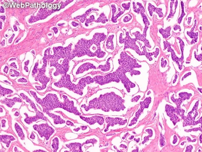 Imaging modality: Bright-field light microscopy of hematoxylin and eosin–stained ovarian tissue sections. Anatomical location: ovary (pelvic region), primary tumor in ovarian parenchyma. Visual features: orderly nests and cords of uniform neuroendocrine cells with round to oval nuclei, scant to moderate cytoplasm, and characteristic finely stippled (salt‑and‑pepper) chromatin; rosette-like structures and trabecular arrangements embedded in delicate stroma; occasional small vascular channels; low-to-moderate mitotic activity; absence or minimal necrosis. Pathology and tissue architecture: organoid nesting with nesting patterns typical of carcinoid tumors; absence of significant mucin production; lack of solid pleomorphic sheets. Pathological findings: consistent with primary ovarian carcinoid tumor (neuroendocrine neoplasm), type insular or trabecular possible; limited atypia; immunohistochemical confirmation typically positive for neuroendocrine markers such as synaptophysin and chromogranin A. Diagnostic significance: histology supports diagnosis of ovarian neuroendocrine tumor; differentiate from metastatic neuroendocrine tumors to the ovary; prognosis depends on size, histologic pattern, and stage; differential diagnoses include granulosa cell tumor with neuroendocrine differentiation and mucinous/serous tumors with focal neuroendocrine features. Clinical correlation: many patients are peri‑ or postmenopausal; potential for carcinoid syndrome with larger tumors; surgical management essential; evaluate for MEN1 syndrome in rare cases; urine 5-HIAA may be elevated; imaging and IHC recommended for confirmation and staging; educational utility in teaching ovarian neuroendocrine neoplasms.