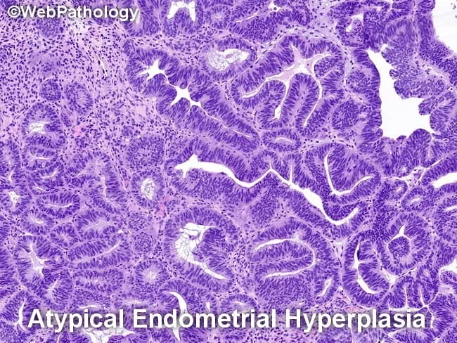 This is a light microscopy image of an endometrial curettage specimen stained with hematoxylin and eosin (H&E), illustrating atypical endometrial hyperplasia within the decidualized endometrium. The biopsy is derived from the uterine cavity lining (endometrium) in a 45-year-old female with abnormal uterine bleeding. Histology shows proliferative glands with marked architectural crowding and back-to-back arrangement, irregular gland outlines, and cribriform-like branching, coupled with cytologic atypia of glandular epithelium. Nuclei are enlarged and hyperchromatic with mild to moderate pleomorphism; nuclear stratification is evident, and mitotic activity may be increased. Stroma remains relatively fibromuscular and less cellular compared to the epithelium. These features define atypical endometrial hyperplasia, a premalignant lesion with substantial risk of progression to endometrioid adenocarcinoma if left untreated. In the clinical context, unopposed estrogen stimulation from estrogen-secreting ovarian neoplasms such as adult granulosa cell tumor may drive endometrial proliferation; therefore, endometrial pathology must be interpreted alongside ovarian findings. Diagnostic significance lies in risk stratification and management decisions, including surveillance, hormonal therapy, or definitive surgical intervention. This image underlines the intersection of gynecologic oncology and endometrial pathology, with educational utility for histology, pathology, gynecology, and medical trainees. Correlation with receptor status and molecular markers may further refine prognosis and therapy.