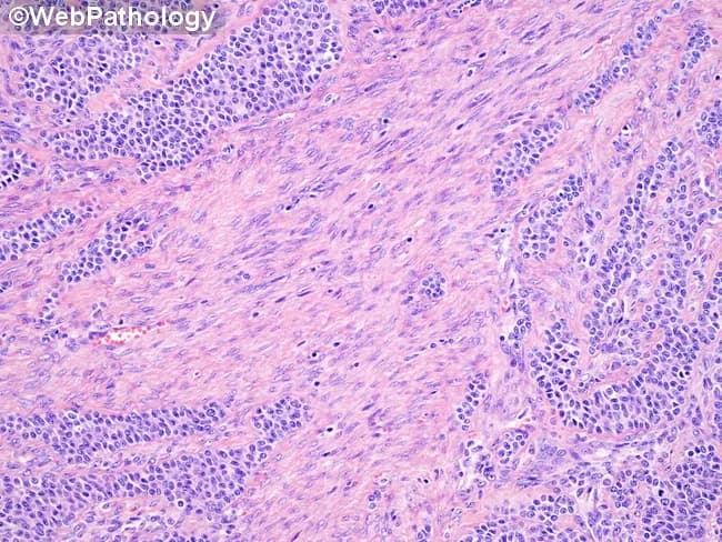 Histopathology, hematoxylin and eosin (H&E) stained slide of ovarian tumor showing fibrothecomatous stroma interposed between cords and sheets of granulosa cells. The tumor displays two components: prominent fibromatous (fibrothecoma-like) stroma and areas of classic granulosa cell proliferation arranged in small solid cords and ill-defined trabeculae. Granulosa cells characteristically exhibit scant cytoplasm and angulated, coffee-bean nuclei with nuclear grooves; occasional Call-Exner bodies (rosette-like microfollicular structures with eosinophilic fluid surrounds) may be present, though in the fibrous zones such features are reduced. The fibrous stroma is variably cellular, with spindle-shaped fibroblasts and collagen deposition; peripherally the diagnostic granulosa cell tumor areas are often evident when the fibrothecomatous component is prominent. The overall pattern is consistent with an adult-type granulosa cell tumor with fibromatous change; this histology can mimic pure fibromas or thecomas if granulosa components are sparse. Immunohistochemical staining typically shows inhibin and calretinin positivity; FOXL2 p.C134W mutation is characteristic but not visible here. Diagnostic significance lies in recognizing the mixed stromal pattern and the granulosa cell cords that support a diagnosis of GCT, which has implications for hormonal activity and potential malignant behavior. Relevance extends to differential diagnosis, surgical planning, and surveillance. This image aids education, pattern recognition, and diagnostic literacy.
