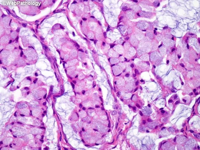 This histopathology image depicts an ovarian metastasis consistent with a Krukenberg tumor. The specimen is an ovarian tissue section prepared for light microscopy and stained with Hematoxylin and Eosin. The primary neoplasm is diffuse-type gastric adenocarcinoma presenting as linitis plastica; however, this image centers on metastatic ovarian involvement. Morphology shows nests and clusters of pleomorphic signet-ring cells with intracellular mucin vacuoles that displace the nucleus to the periphery, producing the characteristic signet-ring appearance. Cells are embedded in a fibromyxoid stromal background with infiltrative spread, occasional acinar-like architecture, and variable cytoplasmic eosinophilia. The mucin-rich cytoplasm yields a pale to empty-appearing cell, contributing to overall discohesive, signet-ring phenotype. The lesion commonly involves both ovaries, though laterality cannot be determined from a single slide. These features reflect metastatic spread from a primary diffuse gastric carcinoma (linitis plastica). Clinically, recognition of signet-ring cell adenocarcinoma in the ovary carries high diagnostic significance: it implies a gastric origin, guides endoscopic evaluation, staging, and systemic therapy, and correlates with poorer prognosis. Differential diagnoses include primary ovarian signet-ring cell/metastatic tumors from breast or colorectal primaries; however, bilateral ovarian involvement with mucin production and the histo-pattern described supports Krukenberg metastasis from gastric cancer.