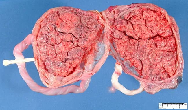 This is a gross pathology photograph of a twin placental specimen illustrating dichorionic diamniotic placentation. The specimen shows two distinct placental masses with rough, lobulated surfaces, separated by a midline tissue interface and paired cord-like structures consistent with separate umbilical cords. The surface texture reveals vascular cores and exposed parenchyma; no obvious infarcts or focal gross lesions are evident in the captured view. The coloration is pink–red with vascular patency visible throughout. A measurement scale is present at the lower margin for size reference. This configuration is compatible with dizygotic twins or monozygotic twins that split early enough to establish two placentas; however, placental dichorionic diamniotic architecture alone cannot reliably determine zygosity. The image provides a clear demonstration of placental architecture, placental margins, and inter-placental tissue that pathologists assess when evaluating twin pregnancies. Clinically, this specimen is relevant to obstetricians and perinatal pathologists for educational purposes, placental pathology review, and maternal-fetal medicine counseling. It supports teaching on chorionicity, amnionicity, and the gross criteria used to infer twin type in placental specimens. This image is suitable for digital teaching modules, literature reviews, and clinical case discussions, helping learners recognize twin placenta morphology, chorionicity criteria, and the limitations of gross assessment today.