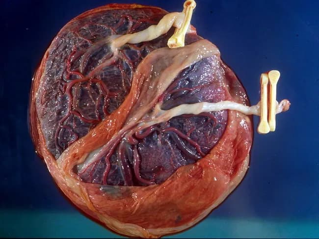 Gross placental specimen from a dichorionic diamniotic twin gestation, presented as a single cross-section showing two distinct placental discs with a zone of partial chorionic plate fusion. The placenta appears rounded and well vascularized, with exposed fetal vasculature and a visible maternal surface, illustrating the vascularized intervillous space and decidual tissue. Each twin’s chorion and amnion are typically separate in DCDA placentas, but this specimen demonstrates greater fusion at the placental margins, creating a continuous placental surface with intermingled villous structures in the fused region. The dual vascular pedicles are evident, and the umbilical cord insertions may be unilateral or near the fusion seam, reflecting the twin gestation pattern. This configuration highlights the complexity of placental contiguity in DCDA pregnancies and raises considerations about potential intertwin vascular anastomoses within the fused area. Notably, the appearance preserves distinguishable cotyledons corresponding to each twin on the maternal surface, while the fused zone represents a morphological variant rather than a complete monochorionic designation. Clinically, such specimens aid in correlating sonographic chorionicity with postnatal placental architecture, inform risk assessment for placental insufficiency or twin-to-twin transfusion in atypical DCDA cases, and provide educational insight into placental development and twin placentation. Aid for education and research.
