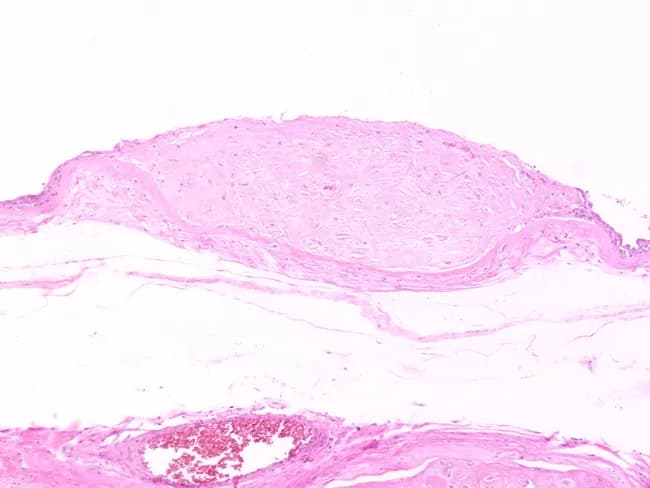 Imaging modality: light microscopy of a hematoxylin and eosin (H&E) stained histology section of the amniotic membrane. Anatomical location: amnion (amniotic membrane) lining the fetal membranes within the intrauterine cavity. Visual features: nodular, eosinophilic amorphous fibrin debris interspersed with entrapped fetal squamous cells derived from fetal epidermis; squames are variably sized, polygonal, with dense cytoplasm and intercellular bridges, occasionally forming small clumps embedded in the fibrin matrix. The architecture shows discrete nodules (amnion nodosum) without prominent inflammatory infiltrate or vascular thrombus. Pathological findings: amnion nodosum composed of amorphous fibrin debris and incorporated fetal squamous cells; interpretation reflects desquamation of fetal skin into amniotic fluid and incorporation into the amnion in the setting of oligohydramnios. Etiology and clinical significance: strongly associated with reduced amniotic fluid volume; serves as a histologic corroboration of oligohydramnios history; generally considered a benign placental membrane change rather than primary fetal pathology. Differential considerations: differentiate from amniotic sheets and other fibrinous deposits by nodular morphology and cellular content. Clinical correlation: correlate with obstetric history, amniotic fluid indices, and placental pathology to aid perinatal diagnosis, prognosis, and educational reference for fetal membrane changes, desquamation processes, and vascular context. Educational tool for pathology residents and obstetric trainees, and clinical researchers alike.